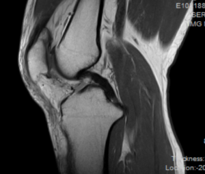 膝の痛みの原因　～画像所見（レントゲン・MRI）～